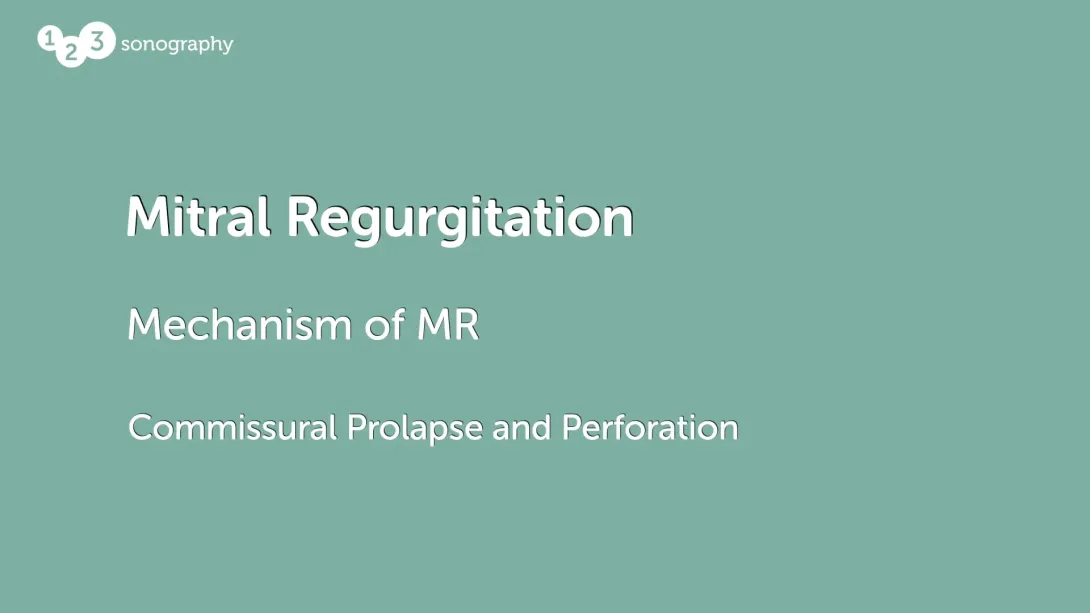 Commissural Prolapse and Perforation