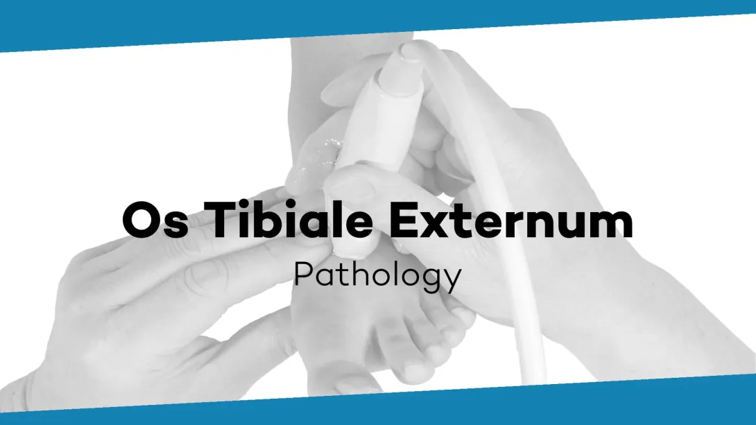 Accessory os naviculare / os tibiale externus type 1,2,3