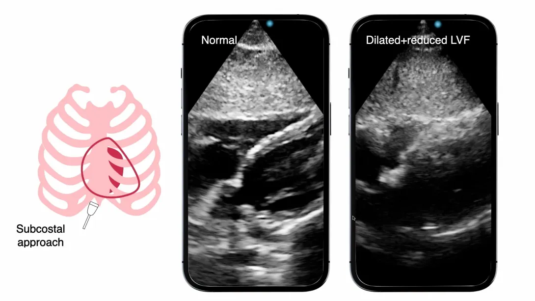 Left ventricular function: Pump's basic mission