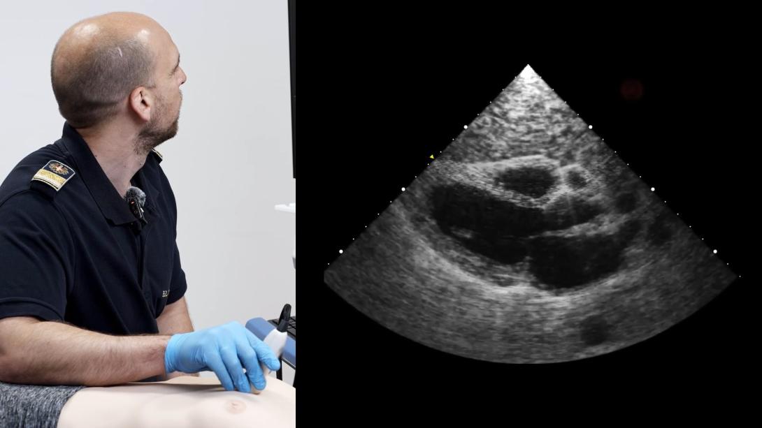 Myocardial Infarction and Wall Motion Abnormalities