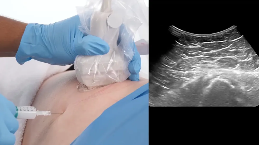 Free lecture 2 - Trochanteric Bursa Injection