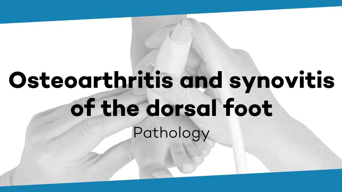 Osteoarthritis and synovitis of the dorsal foot