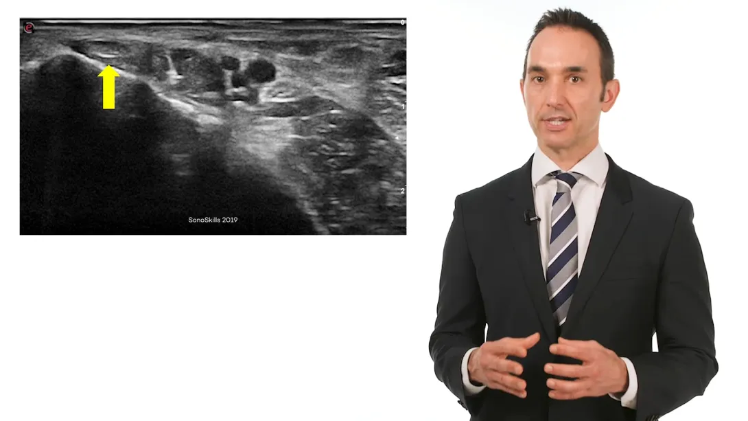 Tib Posterior Injection