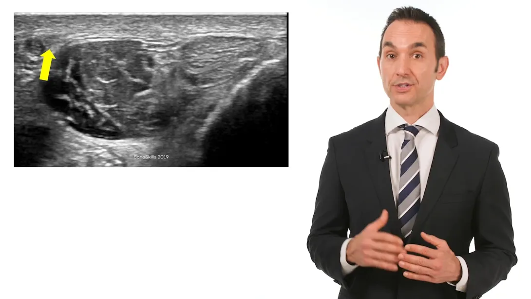 Peroneal tendon sheath Injection