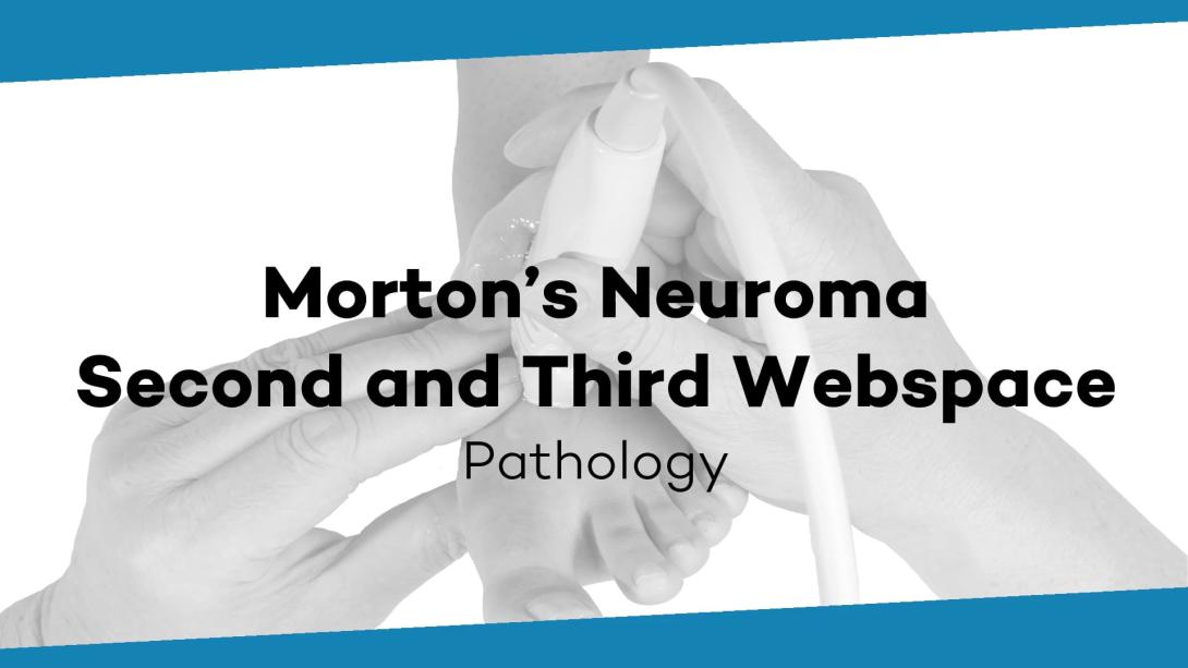 Second and third webspace plantar common digital nerve - Morton neuroma