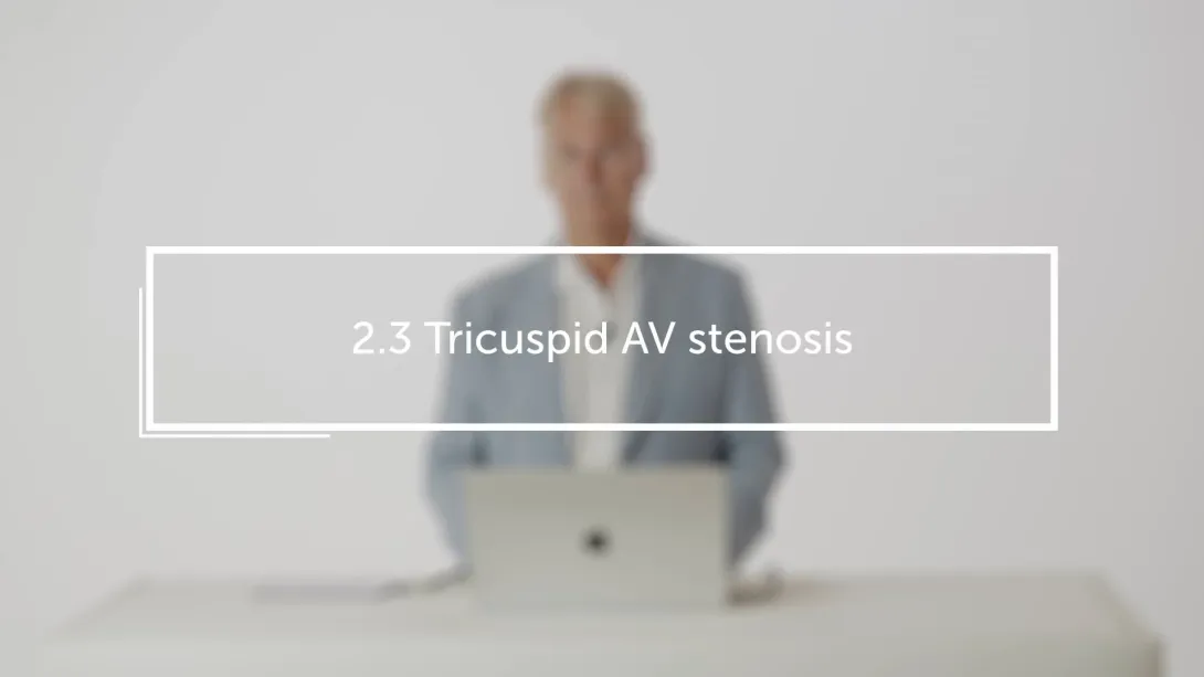 Tricuspid AV stenosis