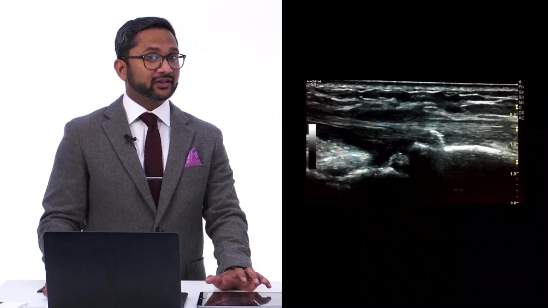 4th extensor compartment case discussion with Suresh Sudula