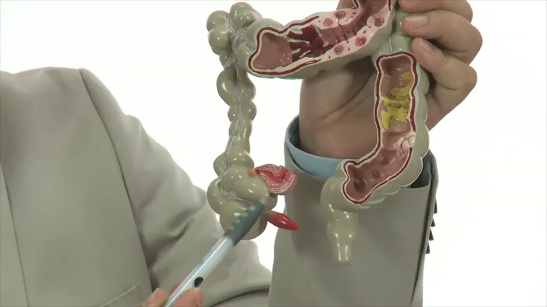 Appendicitis