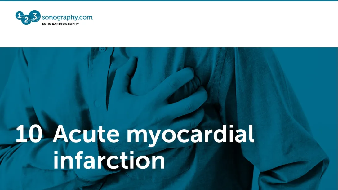 10 - Acute myocardial infarction