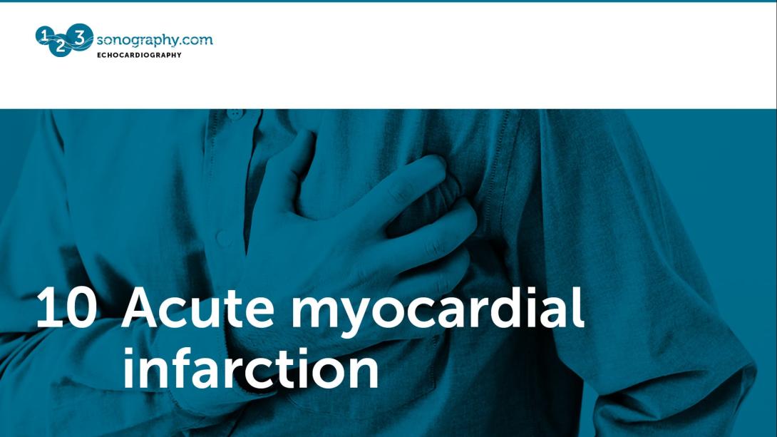 10 - Acute myocardial infarction