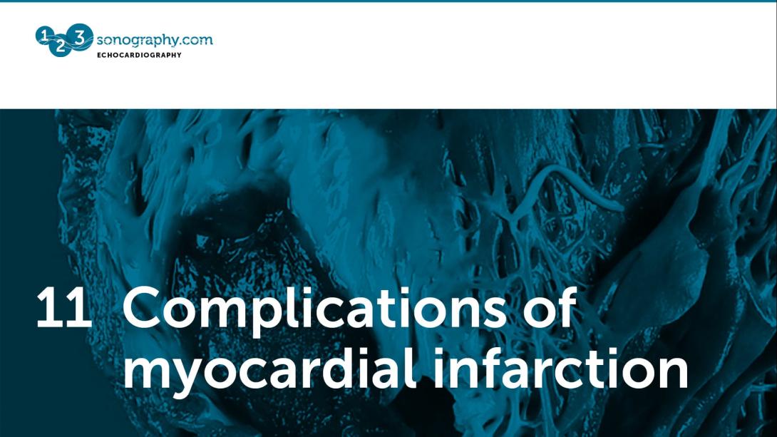 11 - Complications of myocardial infarction