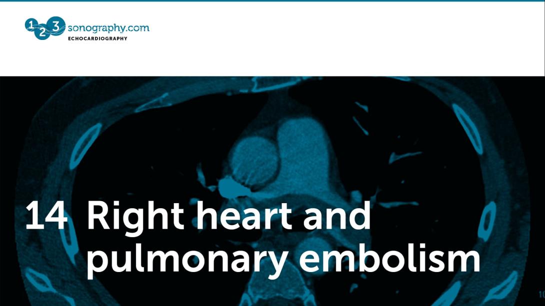 14 - Right heart and pulmonary embolism