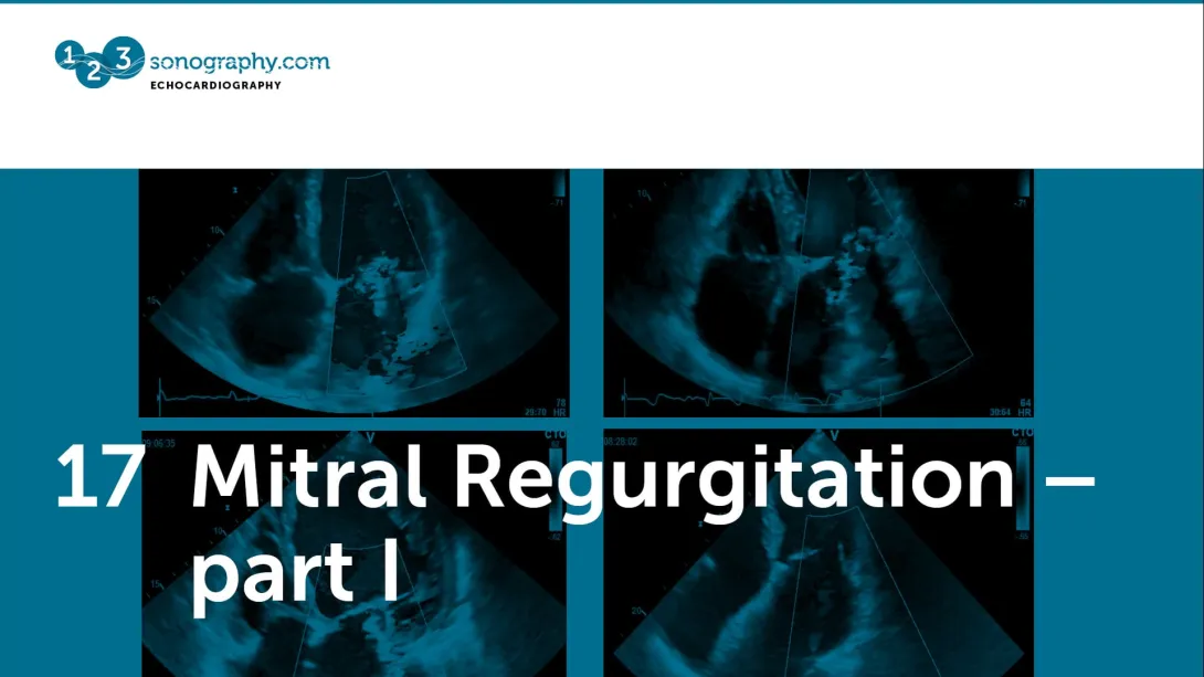 17 - Mitral regurgitation part 1