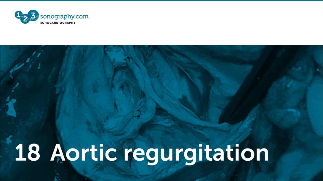 18 - Aortic regurgitation