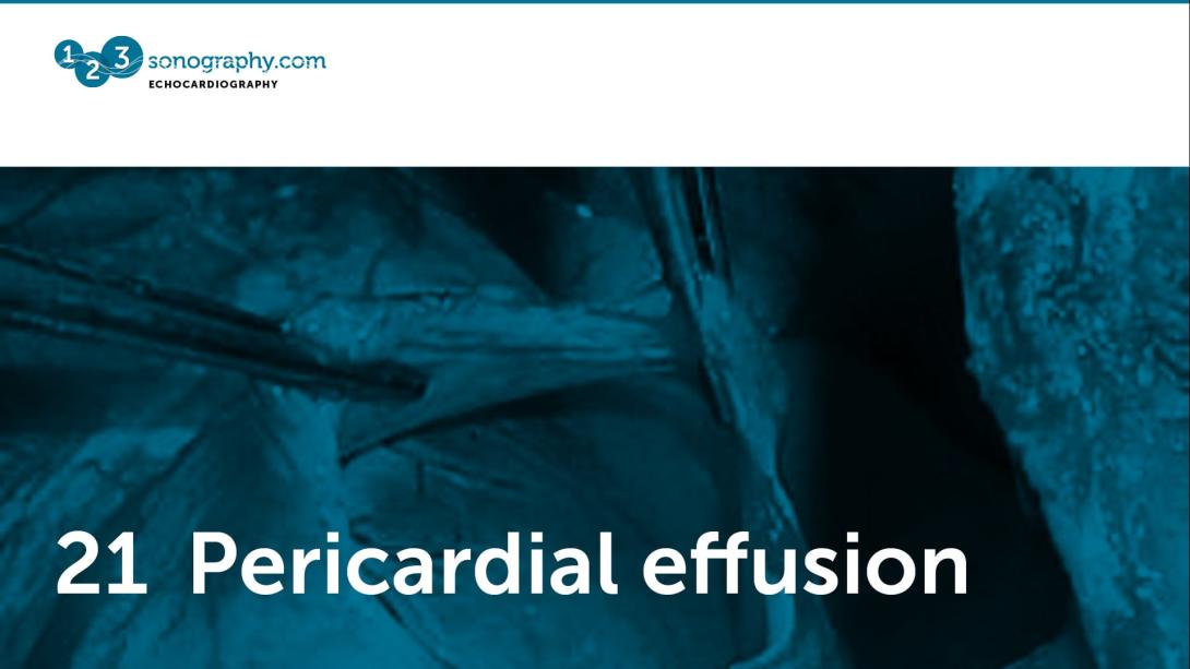 21 - Pericardial effusion