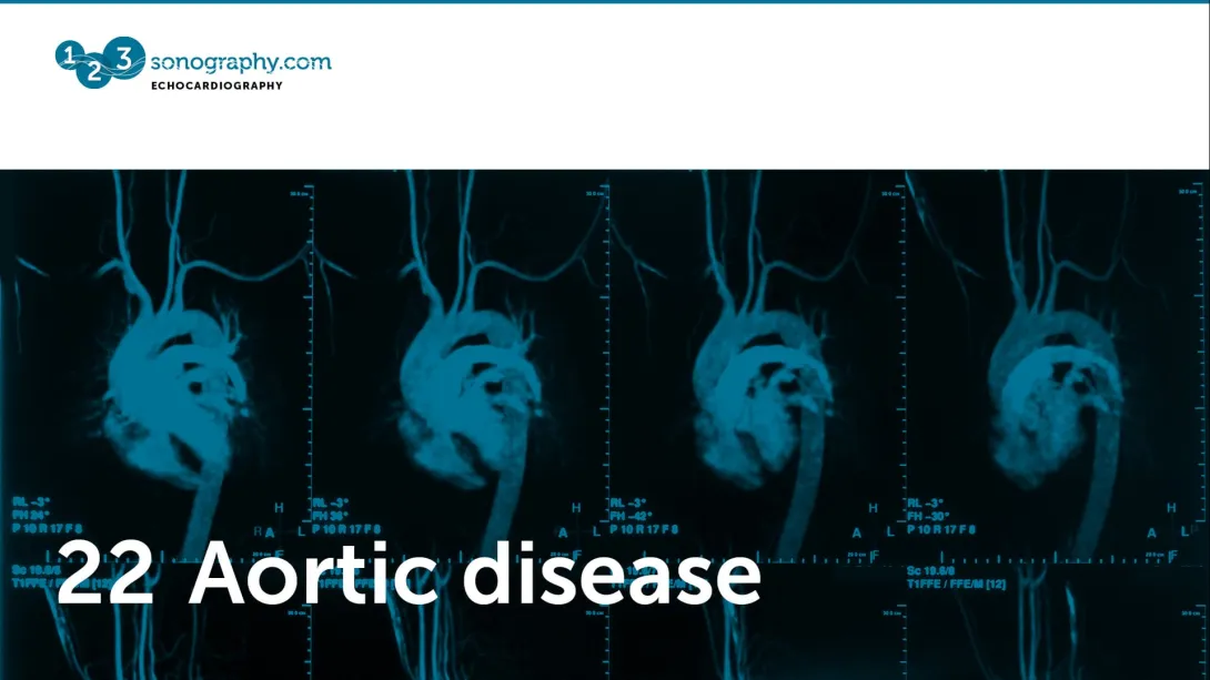 22 - Aortic disease