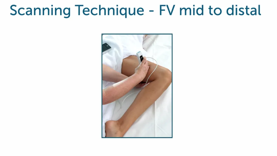 DVT