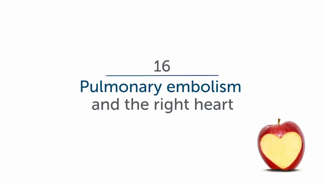 Pulmonary Embolism