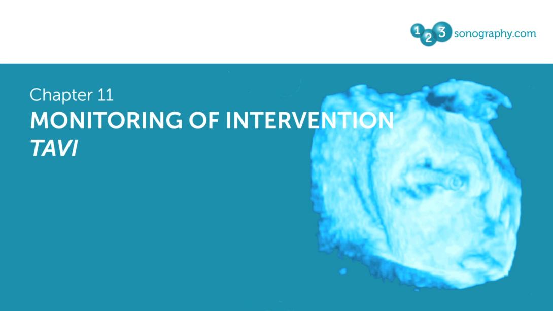 Monitoring of Intervention - TAVI