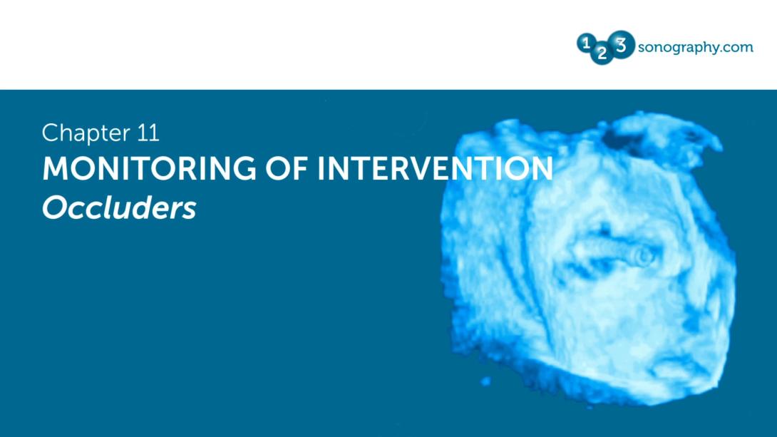 Monitoring of Intervention - Occluders
