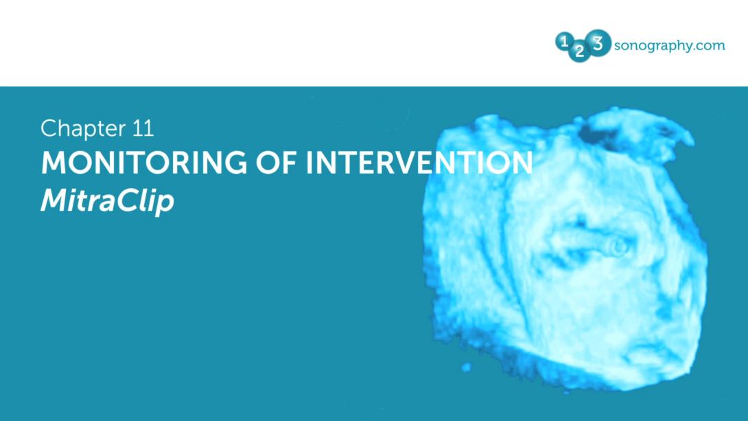 Monitoring of Intervention - MitraClip