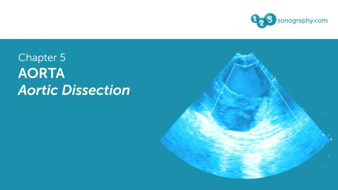 Aorta - Aortic Dissection
