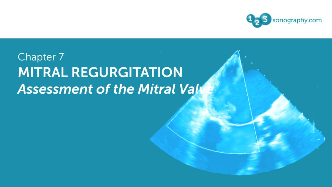 Mitral Regurgitation - Assessment of the Mitral Valve