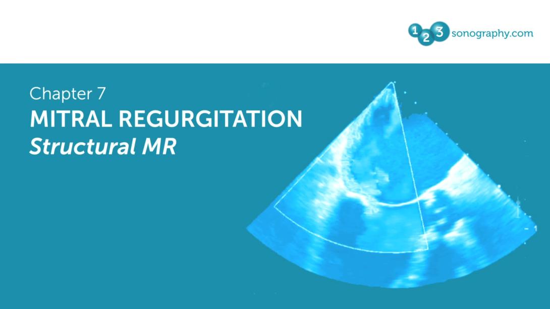 Mitral Regurgitation - Structural MR