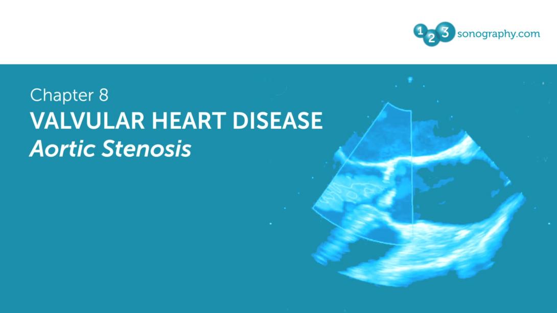 Valvular heart disease - Aortic Stenosis