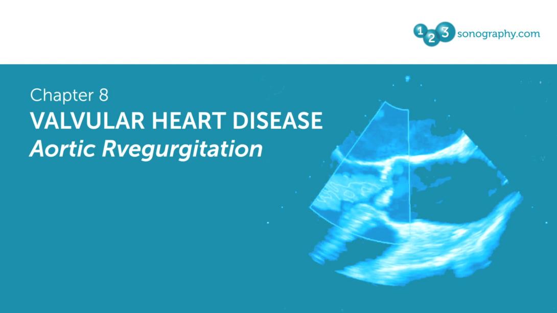 Valvular heart disease -Aortic Regurgitation