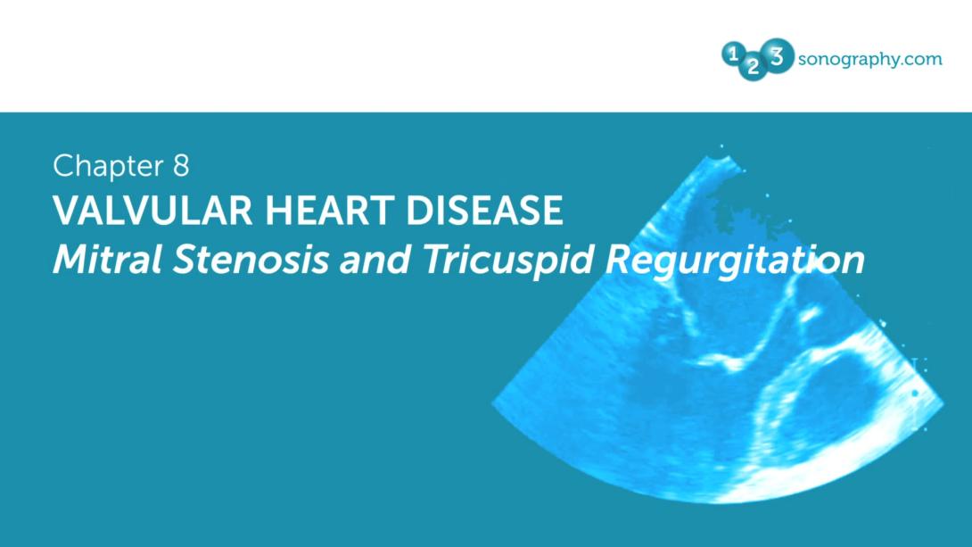 Valvular heart disease - Mitral Stenosis and Tricuspid Regurgitation