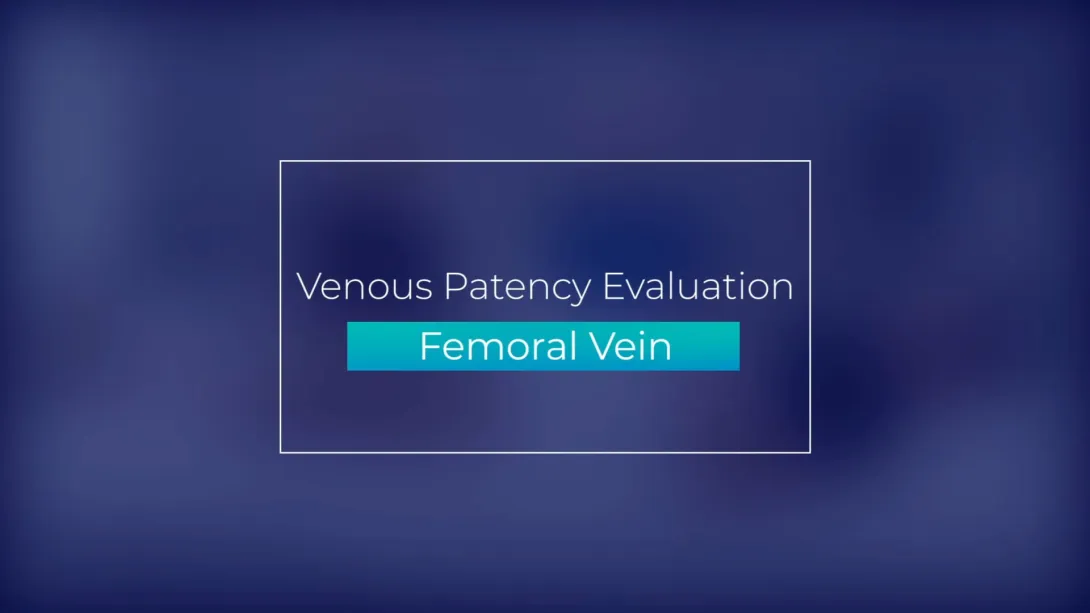 Femoral Vein