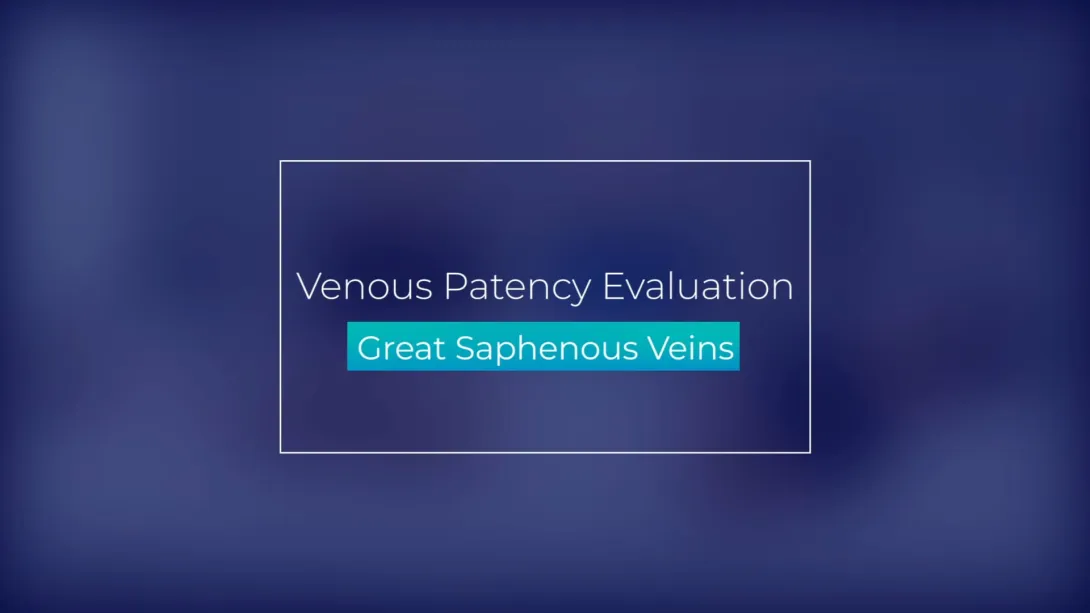 Great Saphenous Veins