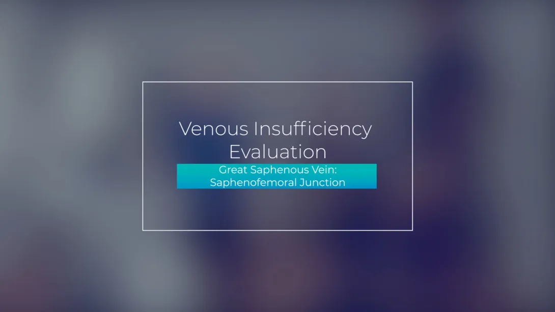 Great Saphenous Vein: Saphenofemoral Junction