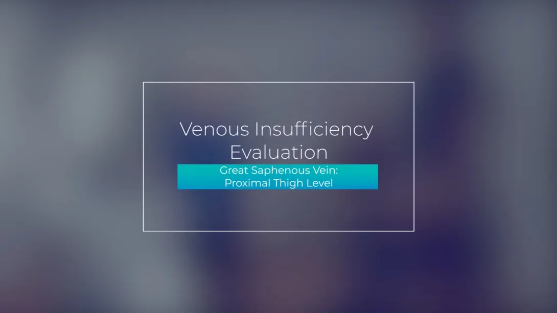 Great Saphenous Vein: Proximal Thigh Level
