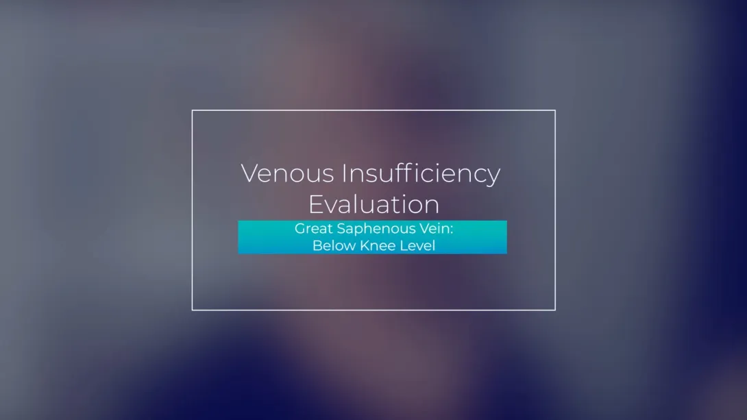 Great Saphenous Vein: Below Knee Level