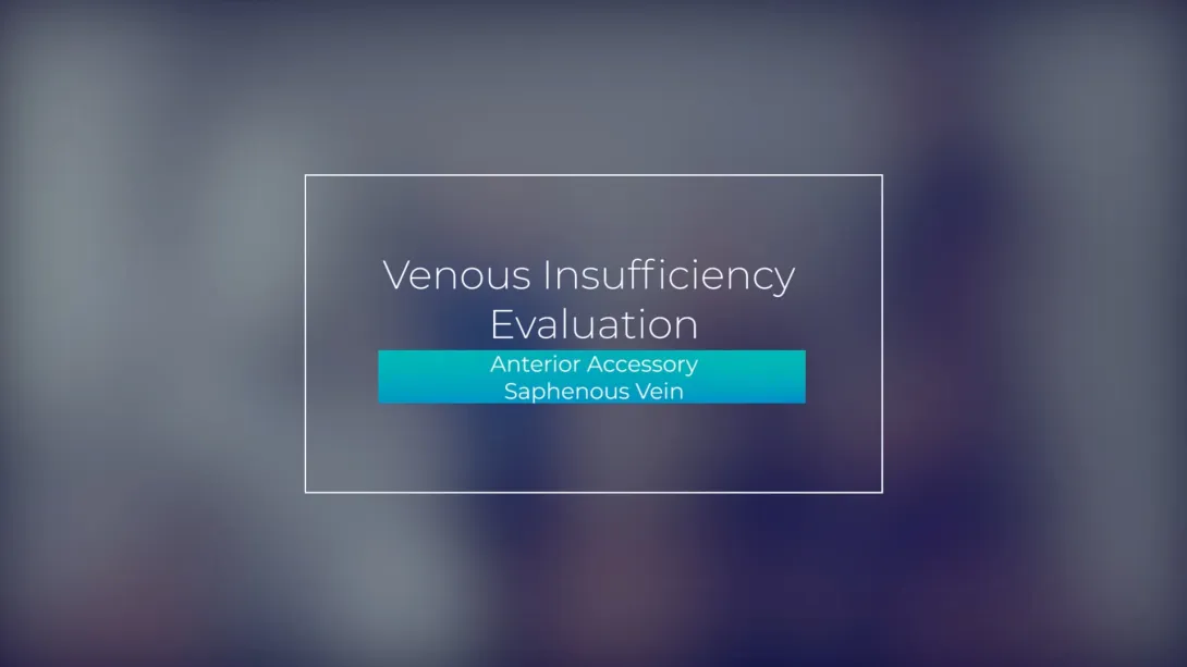 Anterior Accessory Saphenous Vein