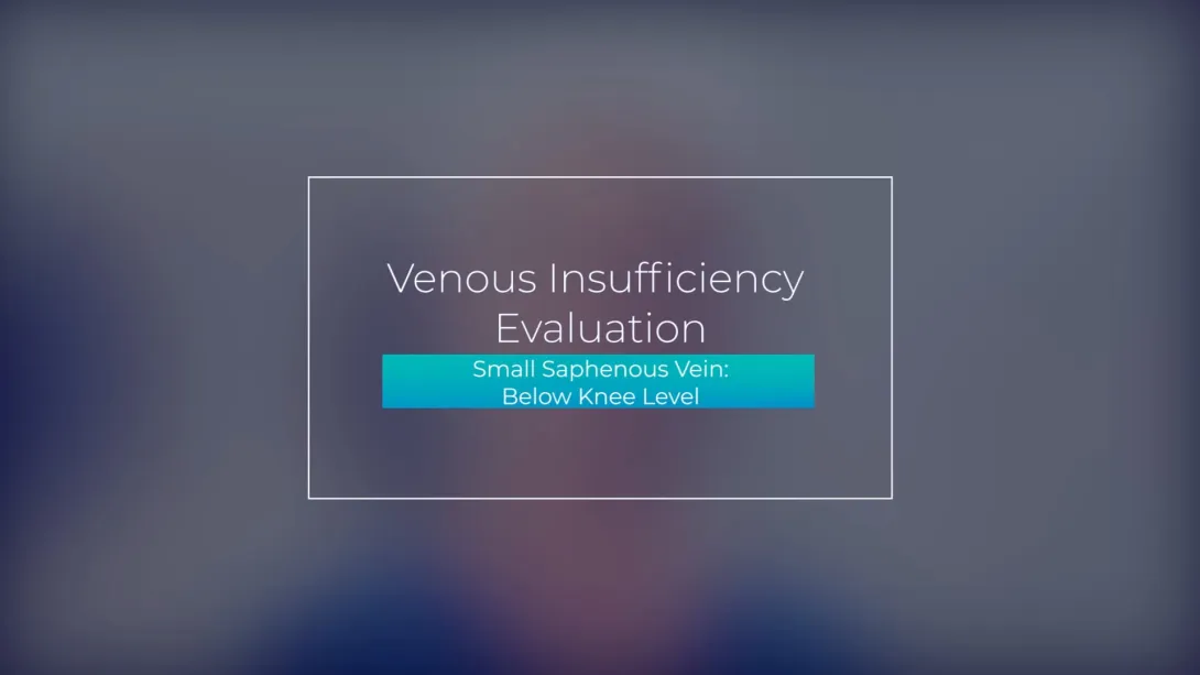 Small Saphenous Vein: Below Knee Level