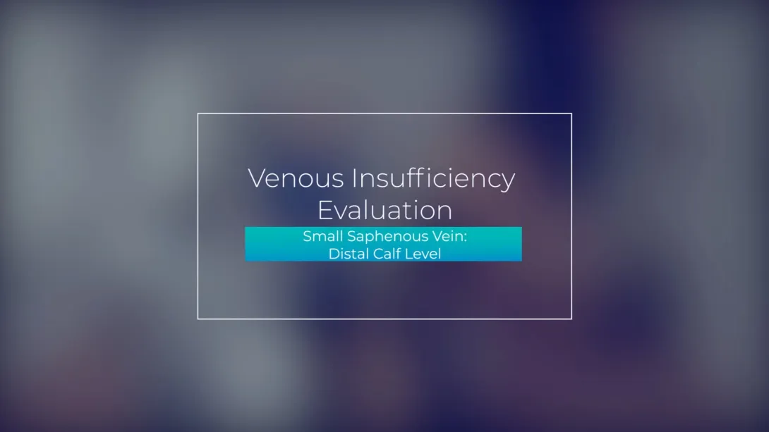 Small Saphenous Vein: Distal Calf Level