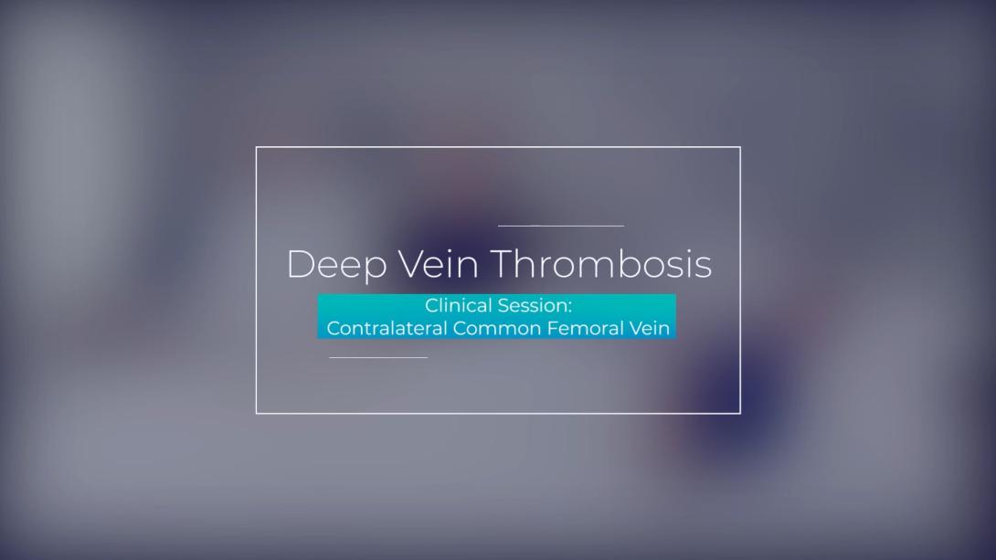Clinical Session: Contralateral Common Femoral Vein