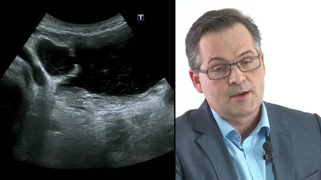 What to find in the urinary bladder?