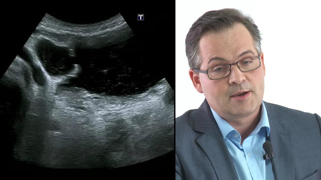 What to find in the urinary bladder?