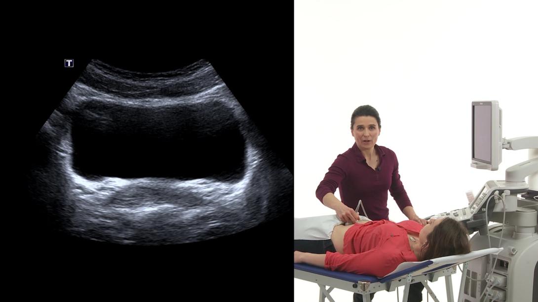 Urinary bladder: Anatomy and how to image