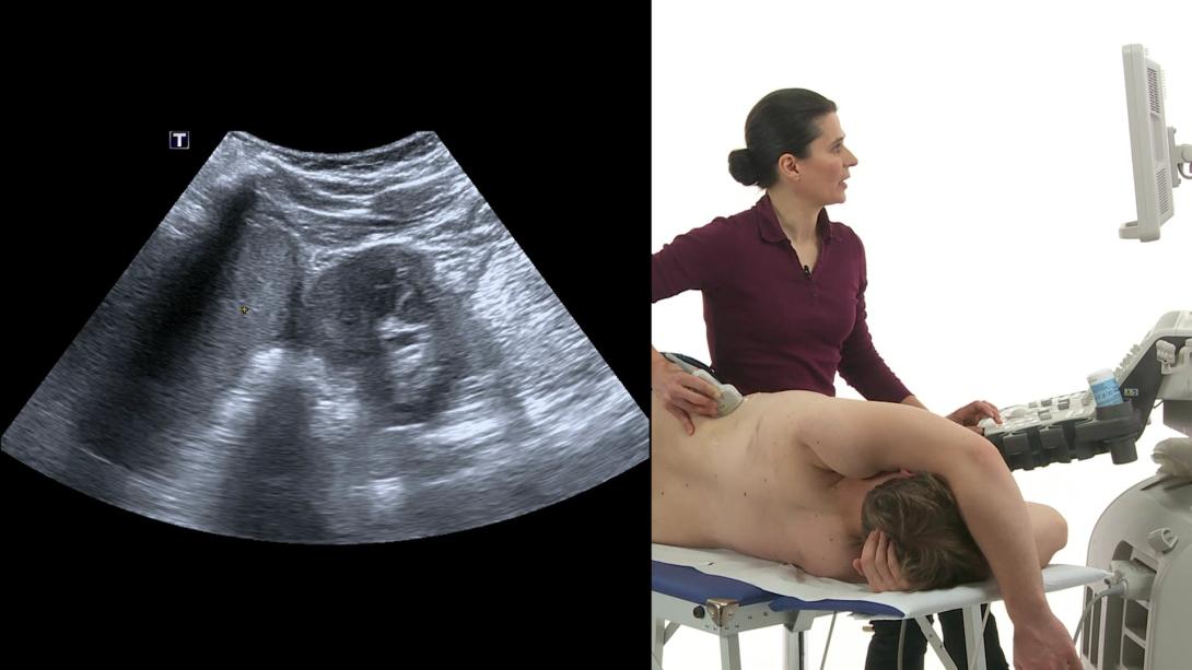 Kidneys: How to image the left kidney