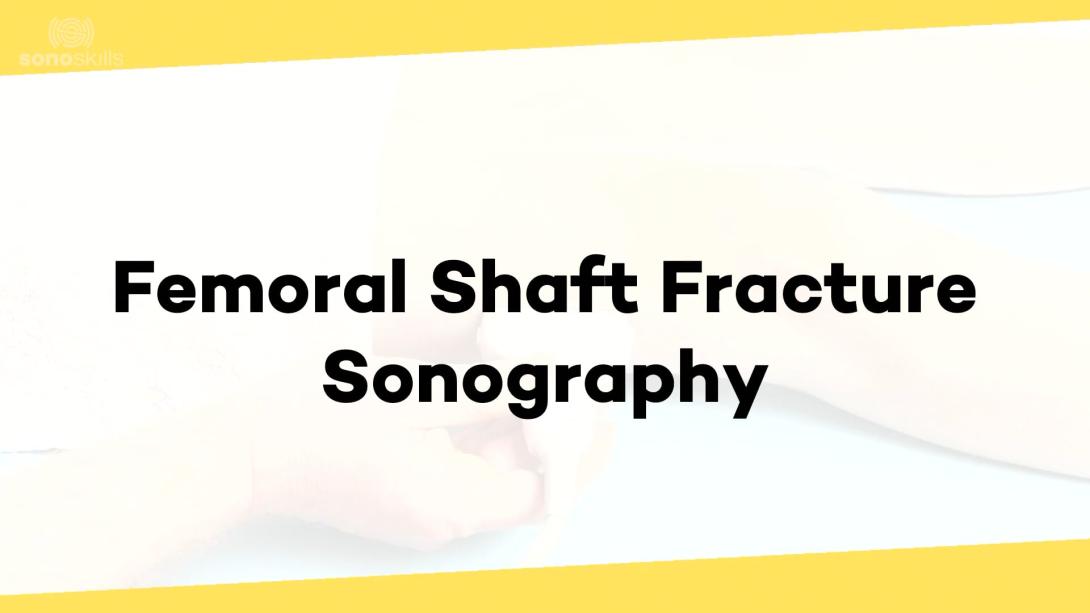 Femoral shaft fractures