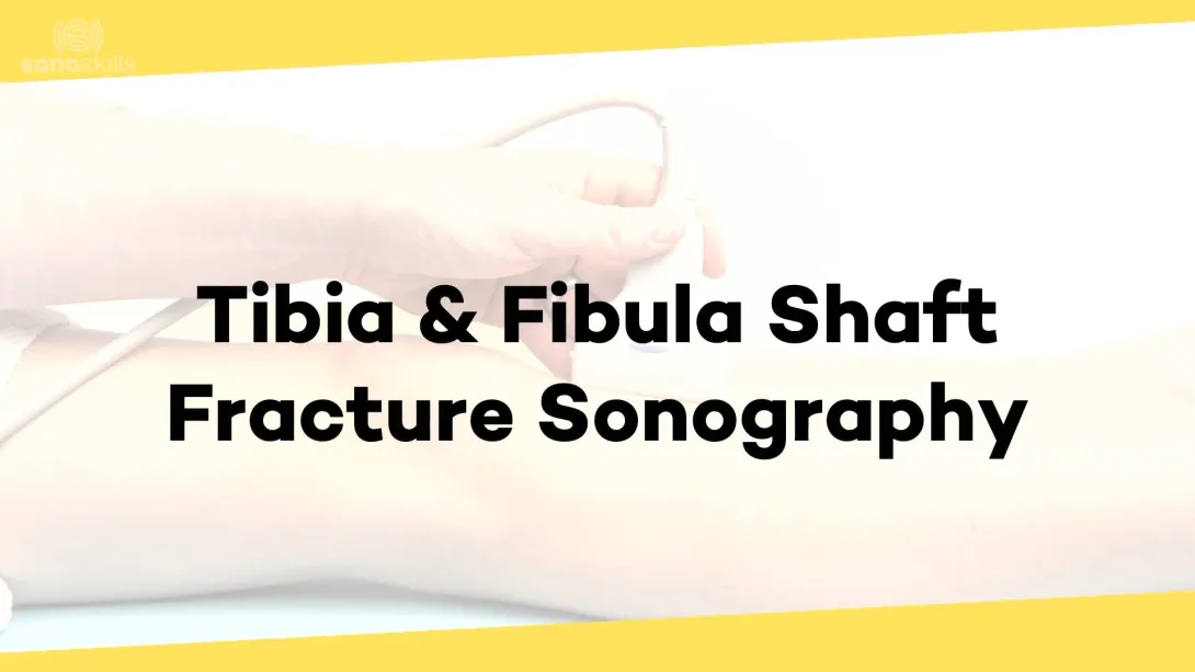 Tibia and fibula shaft fractures