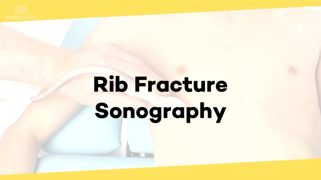 Rib fractures