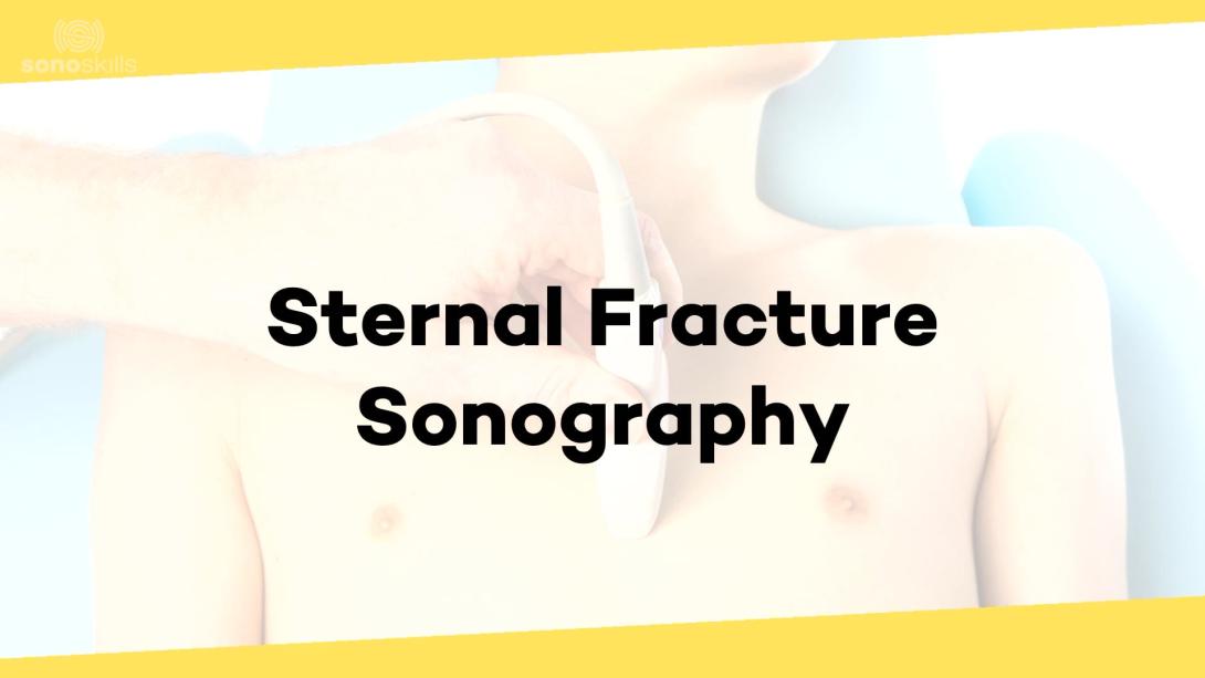 Sternal fractures