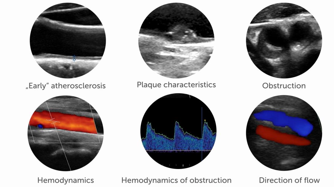 Introduction to carotid ultrasound - Indications