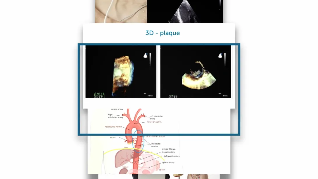 Ascending Aorta